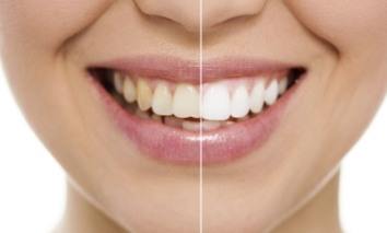 Smile before and after teeth whitening